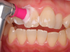 歯 ホワイトニング 値段 PMTC 回転ブラシで研磨
