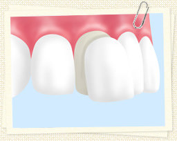 歯 ホワイトニング 値段 ラミネートベニア