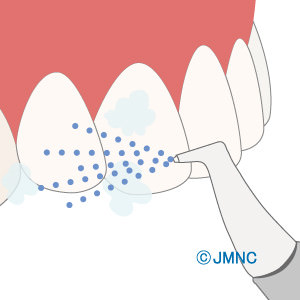 歯 ホワイトニング 値段 PMTC 研磨剤洗浄